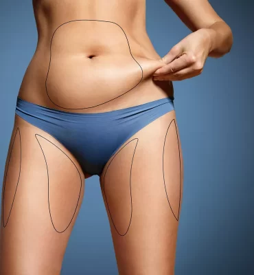 Liposuction: İnatçı Yağlardan Kurtul